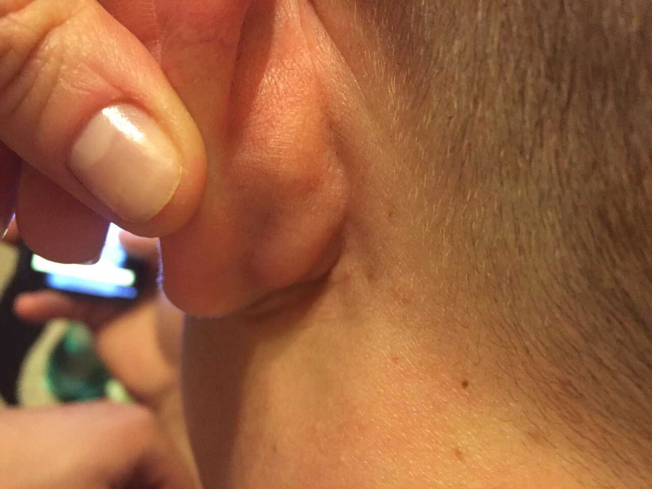 Почему появляется шишка за ухом, и как от нее избавиться